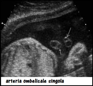 ecografia del cordone ombelicale con arteria singola