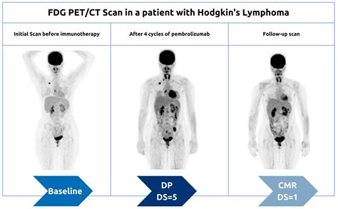 Comparison of TAC and PET in lymphoma