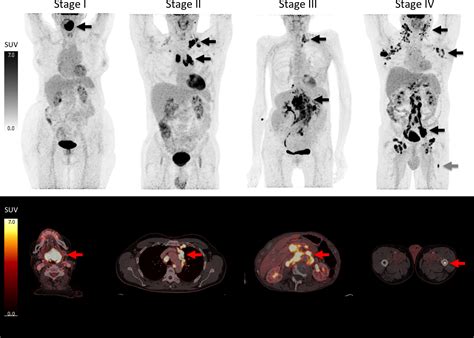 PET-CT scan of lymphoma