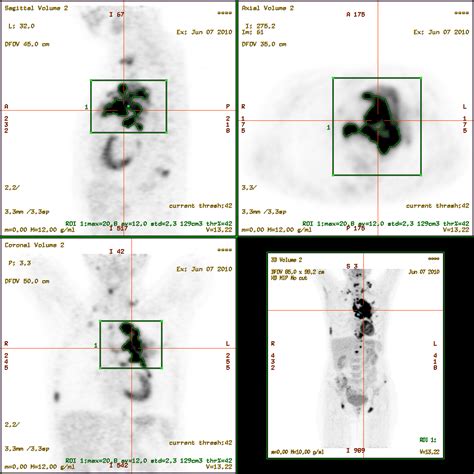 SUV max measurement in PET scan