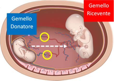 Diagramma che illustra la trasfusione feto fetale