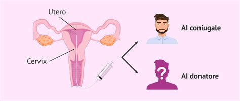 Diagramma che illustra la procedura di inseminazione intrauterina