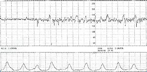 Esame di un tracciato cardiotocografico