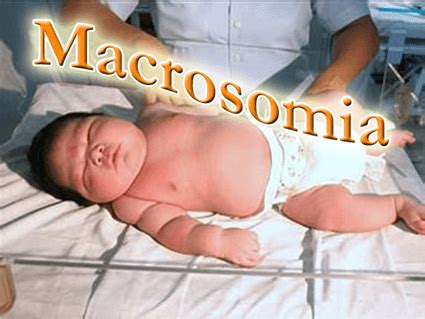 Immagine che illustra un bambino macrosomico