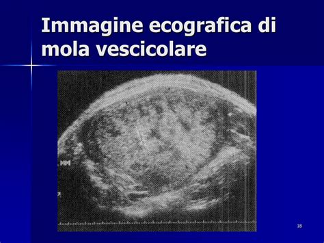 Immagine ecografica di una mola vescicolare