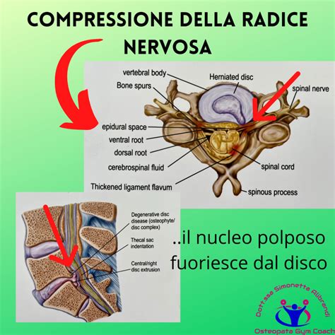 schema dell'avanzamento dell'ago verso la radice nervosa sotto guida ecografica