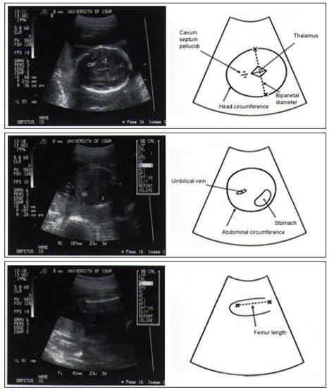 Fetal Growth Restriction Ultrasound