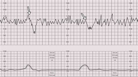 Cardiotocography trace interpretation