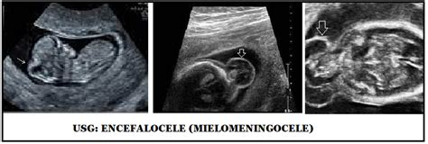 rappresentazione encefalocele fetale