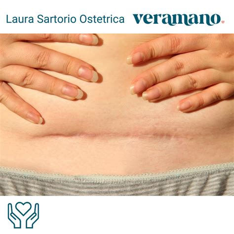 Gracia De Torres mostra la pancia post-parto con cicatrice e smagliature