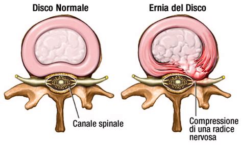 Ernia discale cervicale con compressione radicolare
