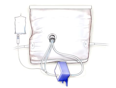Schema del grembo artificiale (biobag)