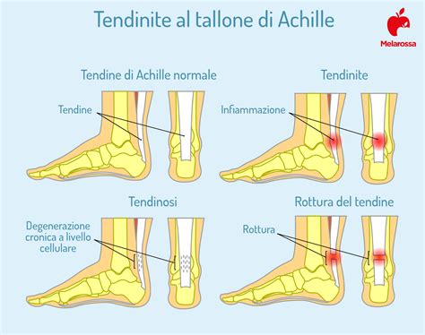 schema grafico del tallone di Achille con indicazione del punto debole