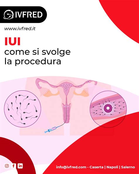 illustrazione del processo di inseminazione intrauterina (IUI)