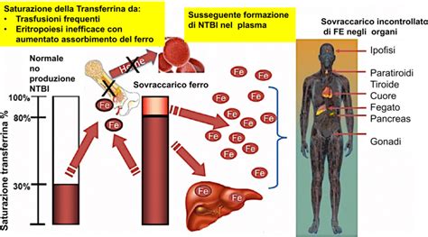 Schema illustrativo degli organi colpiti dal sovraccarico di ferro