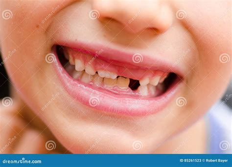 Bambino sorridente con un dente mancante