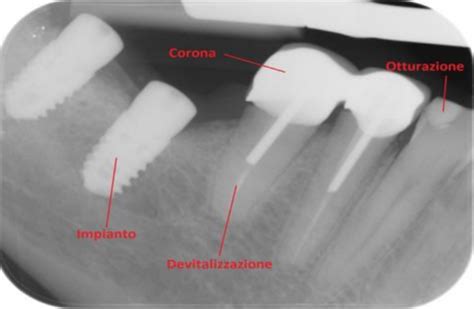 Radiografia dentale che mostra un dente da latte e un dente permanente sottostante