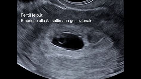 Ecografia a 5 settimane