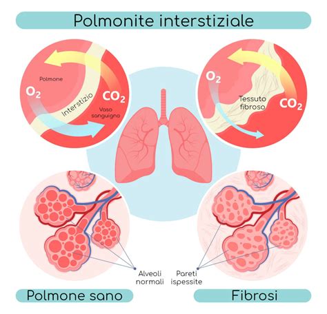 Schema illustrativo riguardante la prevenzione delle malattie polmonari e l'importanza della salute nel settore dello spettacolo