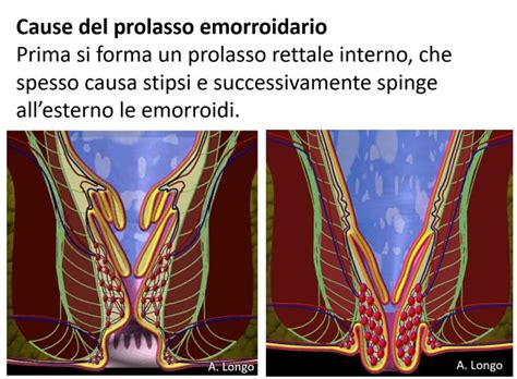 Illustrazione della manovra manuale per il riposizionamento delle emorroidi prolassate