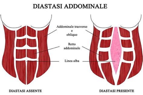 Diastasi addominale prima e dopo intervento chirurgico con addominoplastica