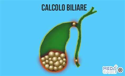 Colecisti con Calcoli Biliari