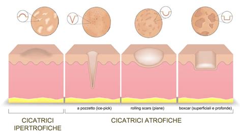Tipi di cicatrici da parto cesareo e consigli per la cura