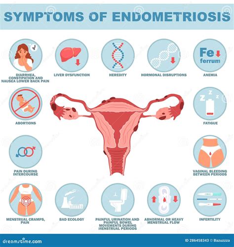 Illustrazione dell'endometriosi