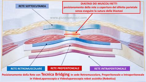 rappresentazione anatomica della zona di incisione del cesareo e gestione dei tessuti