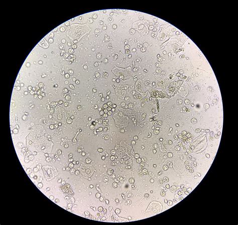 Microscopio che mostra batteri e globuli bianchi in un campione di urina