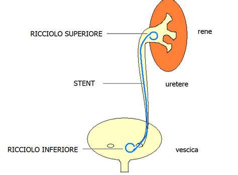 Diagramma che mostra l'ostruzione dell'uretere da un calcolo e il ristagno di urina