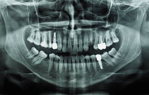 radiografia dentale pediatrica