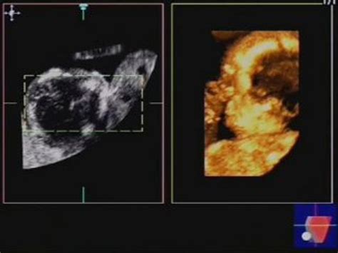 Sindrome Trasfuso-Trasfusore