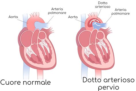Diferenza tra dotto galattoforo normale e ectasico