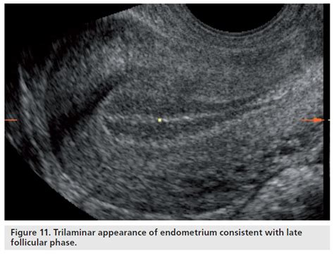 Immagine ecografica di endometrio trilaminare