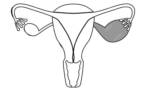 Rappresentazione dell'endometriosi