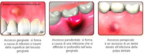 Immagine che mostra il drenaggio di un ascesso dentale