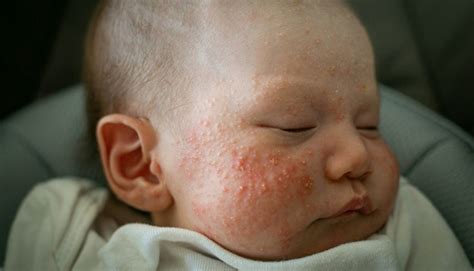 Confronto tra acne neonatale e pelle sana del neonato