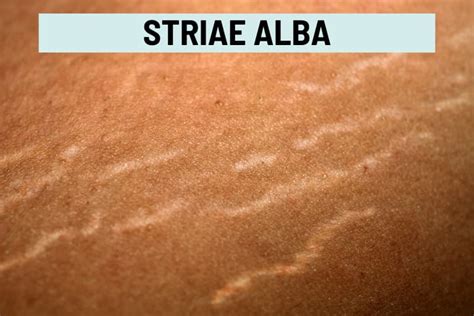 Tipi di smagliature: striae rubrae e striae albae