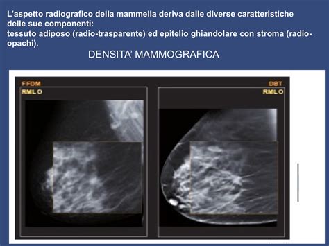 Diagramma della mammografia