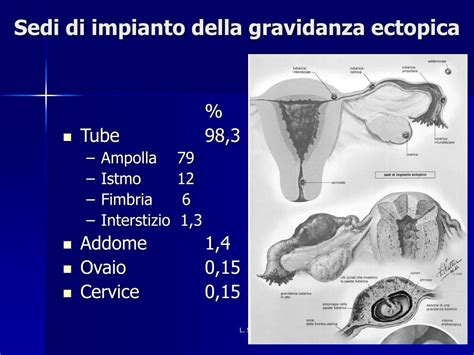 Diagramma delle diverse sedi di gravidanza ectopica