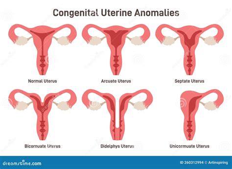 Diagram of uterine structural abnormalities affecting implantation