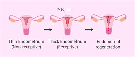 Infographic: Endometrial receptivity factors