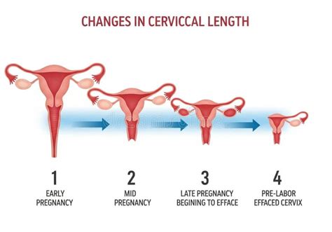 Cervix in pregnancy increased vascularization