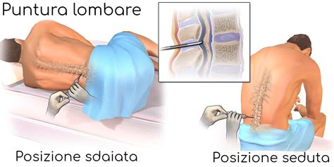 Schema anatomico dei repere per la puntura lombare