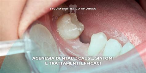 Schema delle cause dell'agenesia dentale