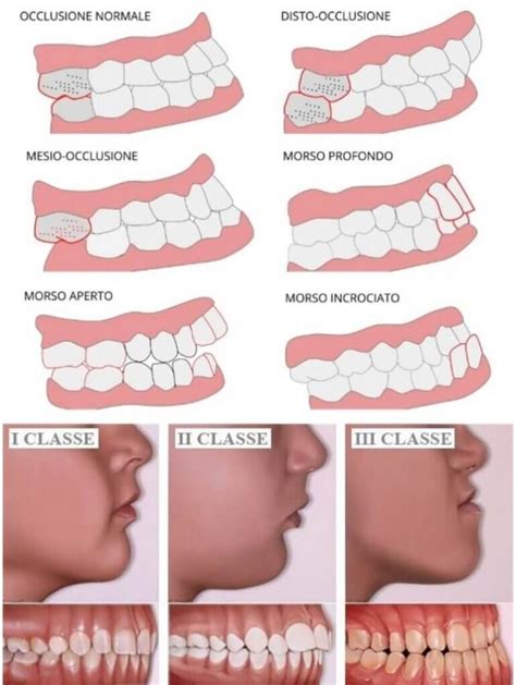 Tipi di trattamento per l'agenesia dentale
