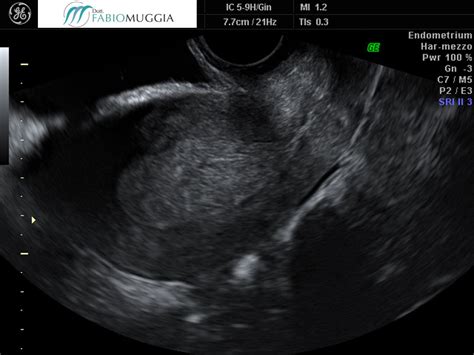 ecografia endometriale