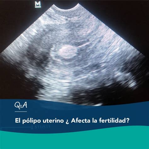 Polipo uterino e fibroma
