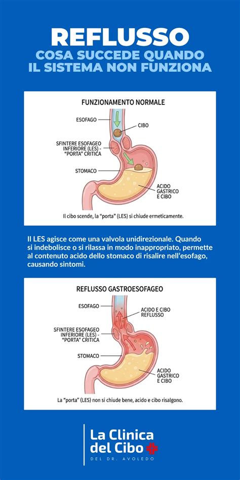 Infografica cause comuni del reflusso neonatale